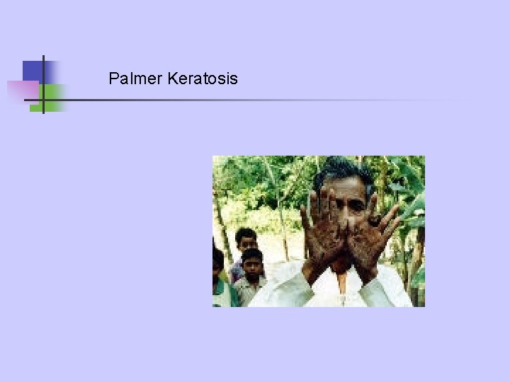 Palmer Keratosis Palmer Keratosis