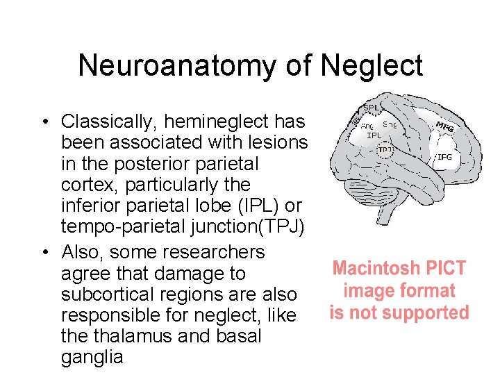 Neuroanatomy of Neglect • Classically, hemineglect has been associated with lesions in the posterior Neuroanatomy of Neglect • Classically, hemineglect has been associated with lesions in the posterior
