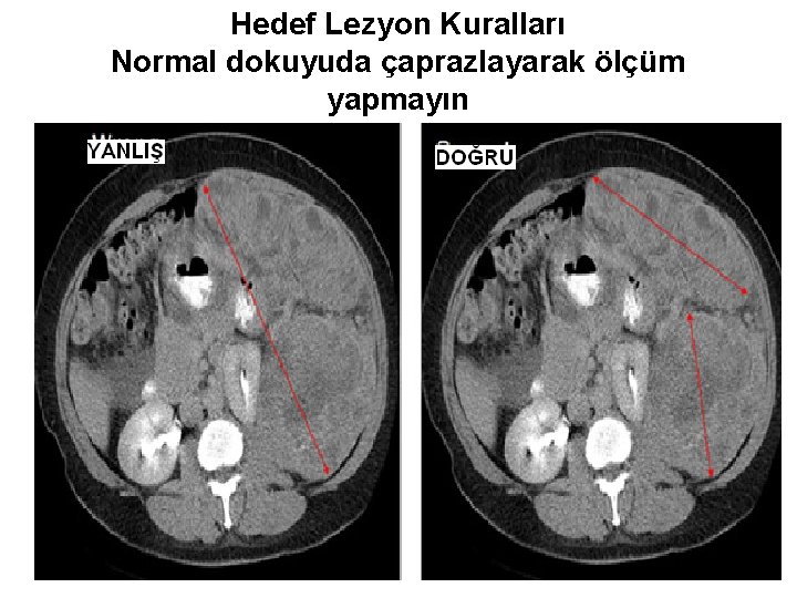 Hedef Lezyon Kuralları Normal dokuyuda çaprazlayarak ölçüm yapmayın 