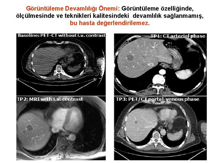 Görüntüleme Devamlılığı Önemi: Görüntüleme özelliğinde, ölçülmesinde ve teknikleri kalitesindeki devamlılık sağlanmamış, bu hasta değerlendirilemez.