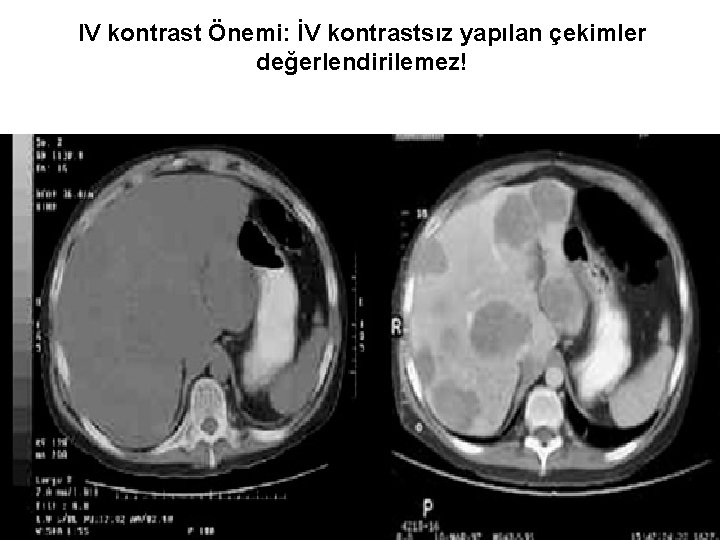 IV kontrast Önemi: İV kontrastsız yapılan çekimler değerlendirilemez! 