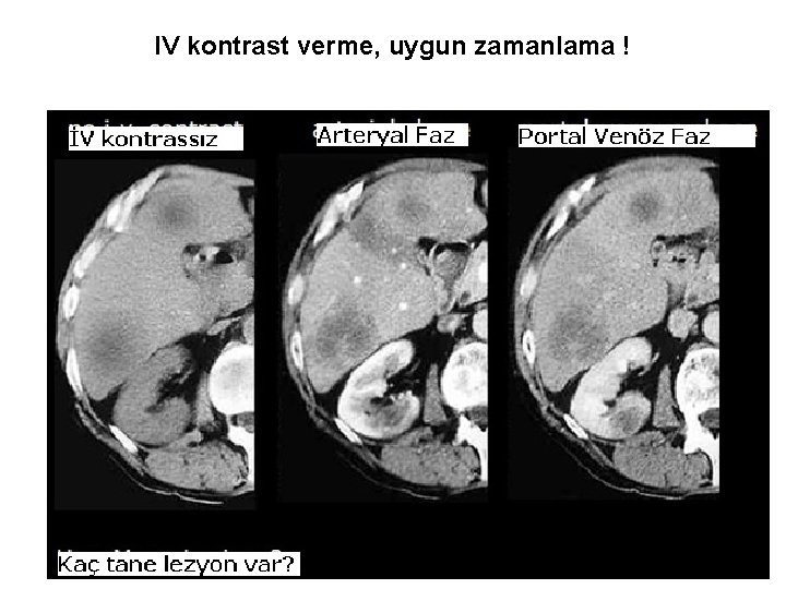 IV kontrast verme, uygun zamanlama ! 