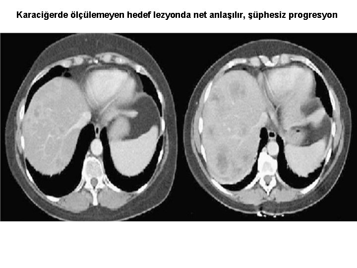 Karaciğerde ölçülemeyen hedef lezyonda net anlaşılır, şüphesiz progresyon 