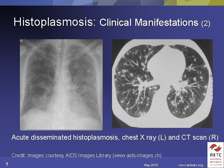 Histoplasmosis: Clinical Manifestations (2) Acute disseminated histoplasmosis, chest X ray (L) and CT scan