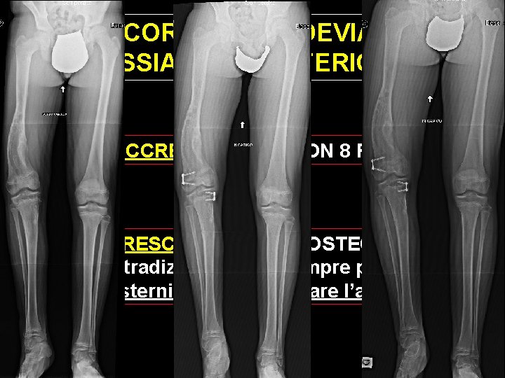 CON CORREZIONE DEVIAZIONI ASSIALI ARTI INFERIORI DURANTE ACCRESCIMENTO CON 8 PLATE A FINE ACCRESCIMENTO CON CORREZIONE DEVIAZIONI ASSIALI ARTI INFERIORI DURANTE ACCRESCIMENTO CON 8 PLATE A FINE ACCRESCIMENTO