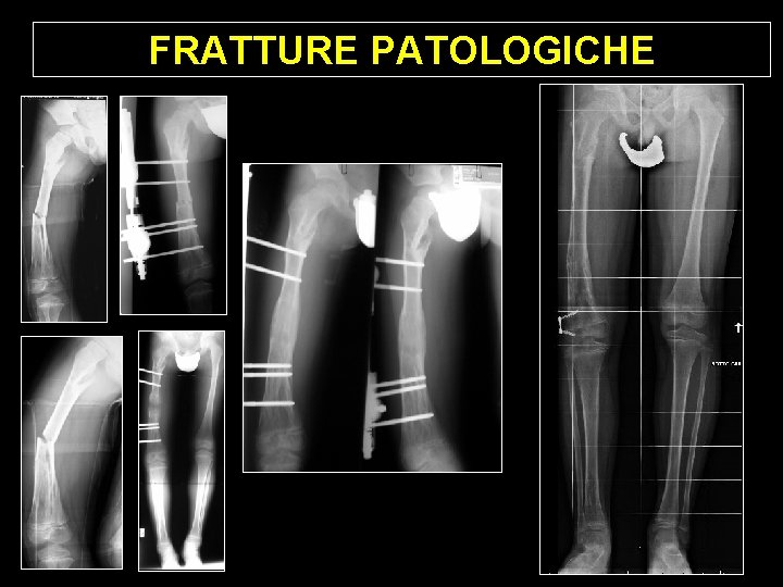 FRATTURE PATOLOGICHE FRATTURE PATOLOGICHE