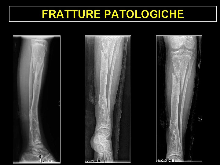 FRATTURE PATOLOGICHE FRATTURE PATOLOGICHE