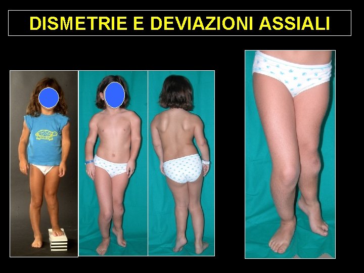 DISMETRIE E DEVIAZIONI ASSIALI DISMETRIE E DEVIAZIONI ASSIALI