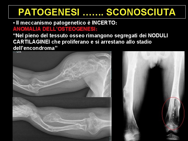 PATOGENESI ……. SCONOSCIUTA • Il meccanismo patogenetico è INCERTO: ANOMALIA DELL’OSTEOGENESI: “Nel pieno del PATOGENESI ……. SCONOSCIUTA • Il meccanismo patogenetico è INCERTO: ANOMALIA DELL’OSTEOGENESI: “Nel pieno del