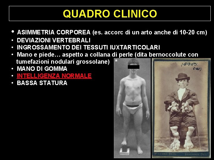 QUADRO CLINICO • ASIMMETRIA CORPOREA (es. accorc di un arto anche di 10 -20 QUADRO CLINICO • ASIMMETRIA CORPOREA (es. accorc di un arto anche di 10 -20