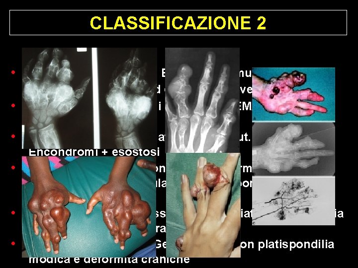 CLASSIFICAZIONE 2 • TIPO 1: Mal. Di Ollier: Encondromi multipli ossa • • • CLASSIFICAZIONE 2 • TIPO 1: Mal. Di Ollier: Encondromi multipli ossa • • •