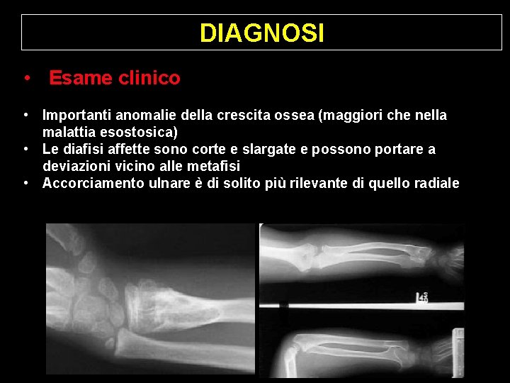 DIAGNOSI • Esame clinico • Importanti anomalie della crescita ossea (maggiori che nella malattia DIAGNOSI • Esame clinico • Importanti anomalie della crescita ossea (maggiori che nella malattia