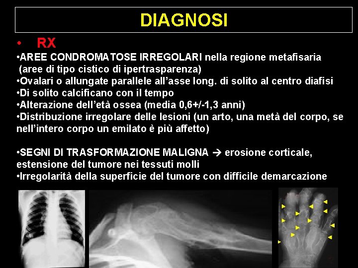DIAGNOSI • RX • AREE CONDROMATOSE IRREGOLARI nella regione metafisaria (aree di tipo cistico DIAGNOSI • RX • AREE CONDROMATOSE IRREGOLARI nella regione metafisaria (aree di tipo cistico