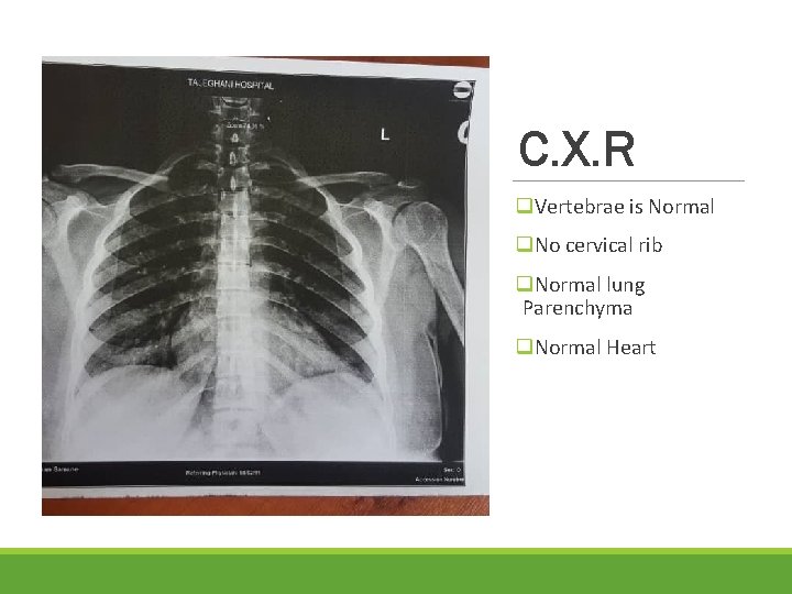 C. X. R q. Vertebrae is Normal q. No cervical rib q. Normal lung