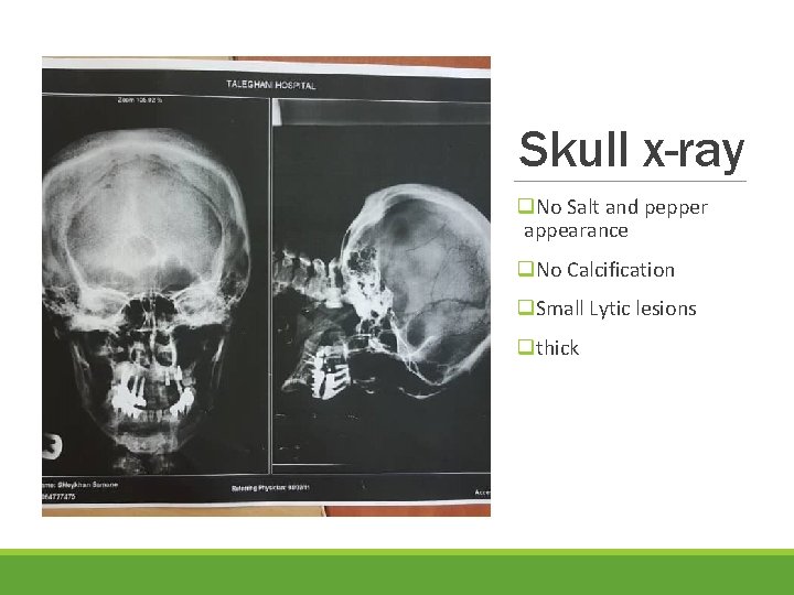 Skull x-ray q. No Salt and pepper appearance q. No Calcification q. Small Lytic
