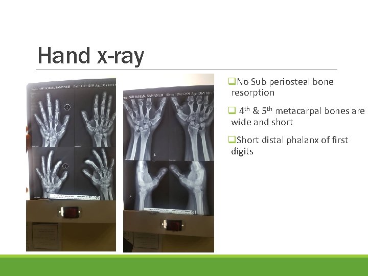 Hand x-ray q. No Sub periosteal bone resorption q 4 th & 5 th