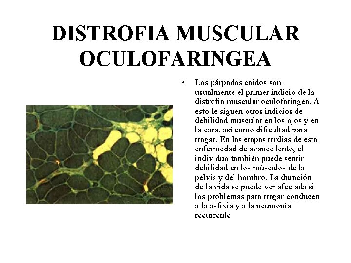 DISTROFIA MUSCULAR OCULOFARINGEA • Los párpados caídos son usualmente el primer indicio de la