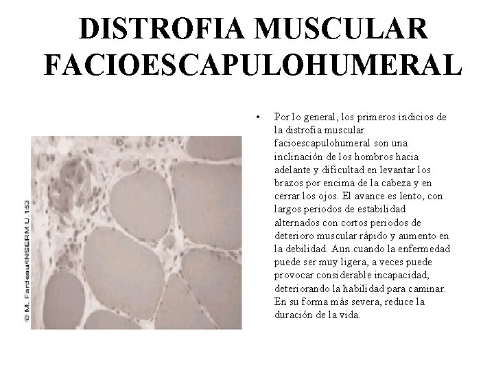 DISTROFIA MUSCULAR FACIOESCAPULOHUMERAL • Por lo general, los primeros indicios de la distrofia muscular