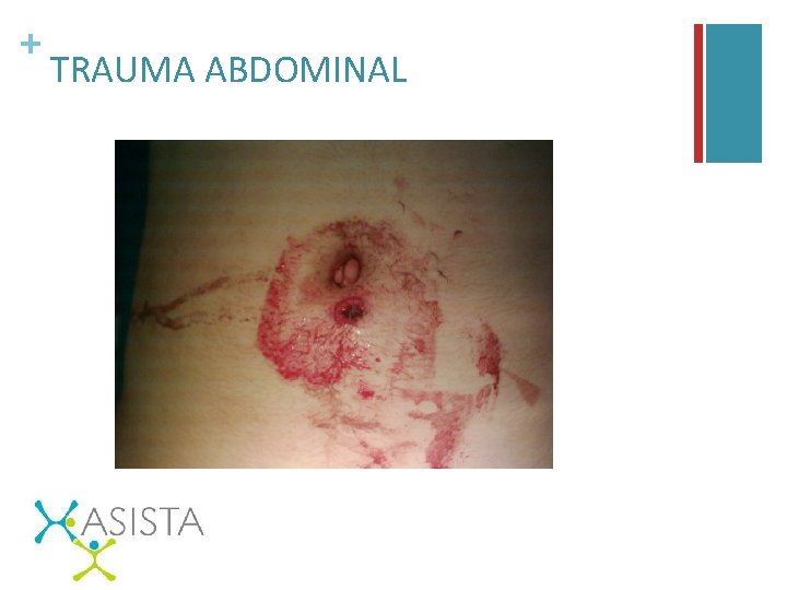 + TRAUMA ABDOMINAL 