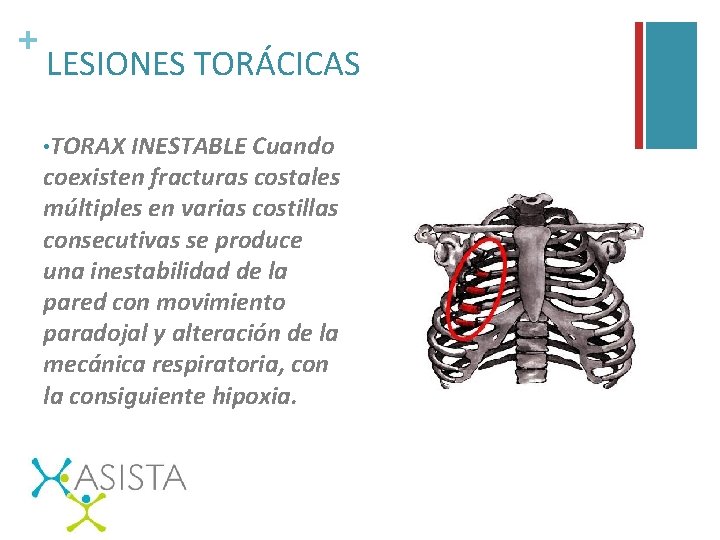 + LESIONES TORÁCICAS • TORAX INESTABLE Cuando coexisten fracturas costales múltiples en varias costillas