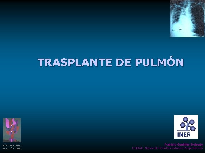 TRASPLANTE DE PULMÓN Árbol de la Vida. Sebastián. 1996. Patricio Santillán Doherty Instituto Nacional