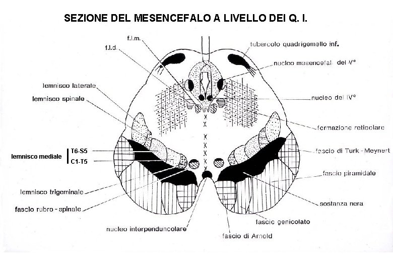 SEZIONE DEL MESENCEFALO A LIVELLO DEI Q. I. lemnisco mediale T 6 -S 5