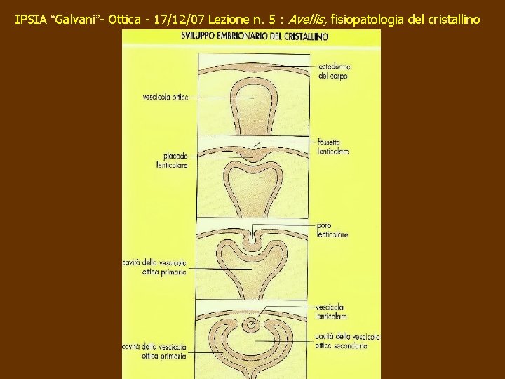 IPSIA “Galvani”- Ottica - 17/12/07 Lezione n. 5 : Avellis, fisiopatologia del cristallino 