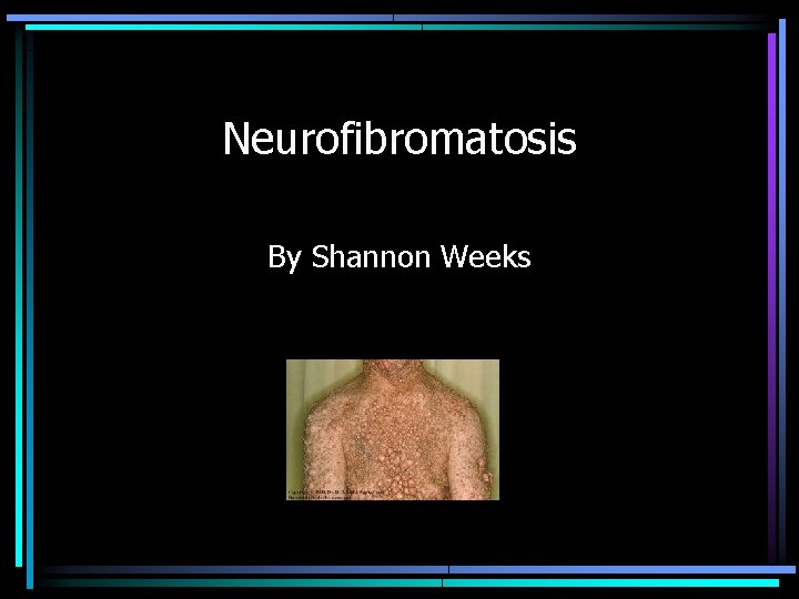 Neurofibromatosis By Shannon Weeks 