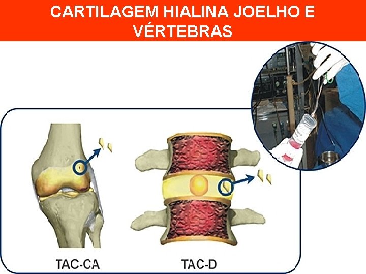 CARTILAGEM HIALINA JOELHO E VÉRTEBRAS 