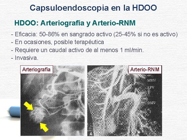 Capsuloendoscopia en la HDOO: Arteriografía y Arterio-RNM - Eficacia: 50 -86% en sangrado activo