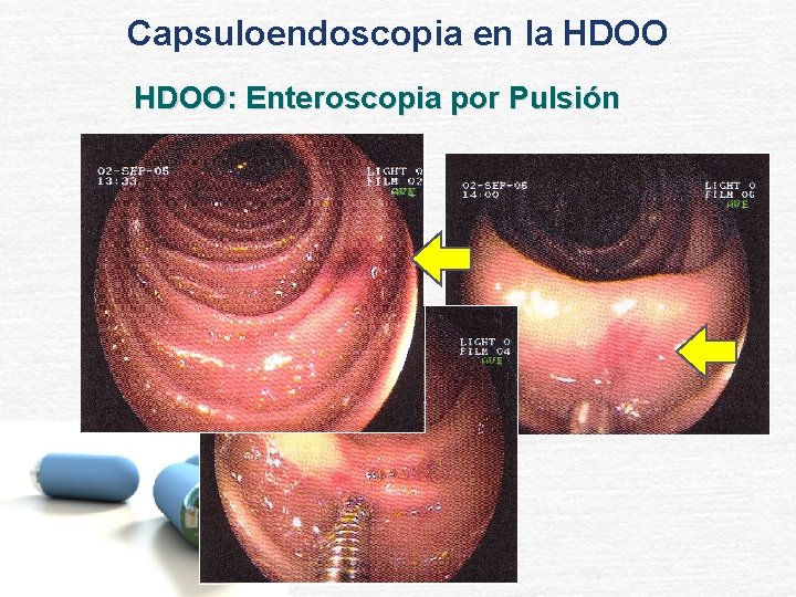 Capsuloendoscopia en la HDOO: Enteroscopia por Pulsión 