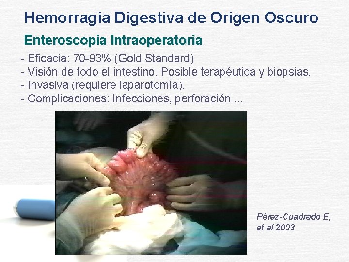 Hemorragia Digestiva de Origen Oscuro Enteroscopia Intraoperatoria - Eficacia: 70 -93% (Gold Standard) -
