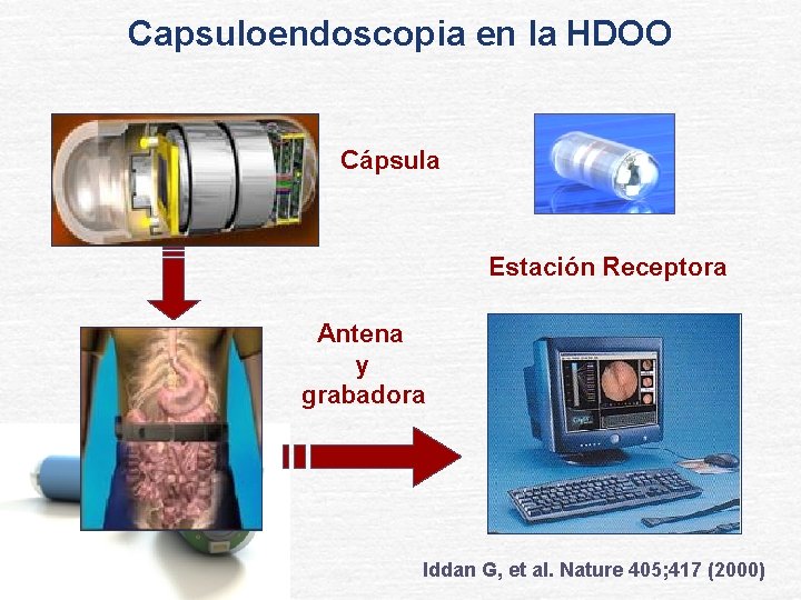 Capsuloendoscopia en la HDOO Cápsula Estación Receptora Antena y grabadora Iddan G, et al.