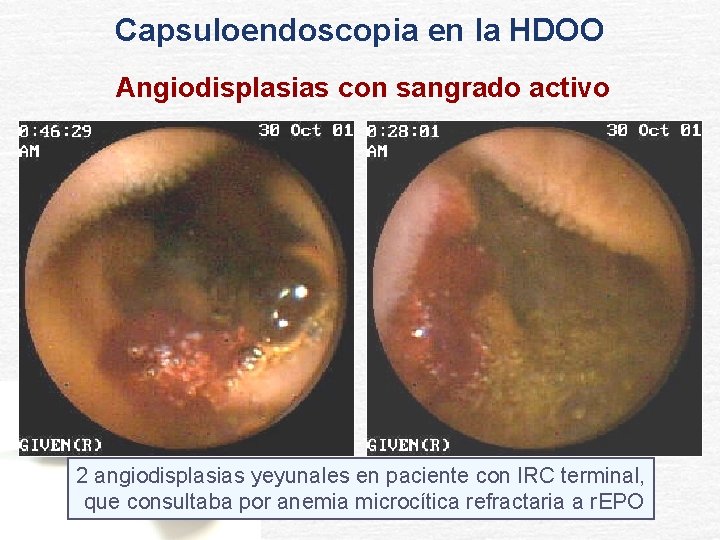 Capsuloendoscopia en la HDOO Angiodisplasias con sangrado activo 2 angiodisplasias yeyunales en paciente con