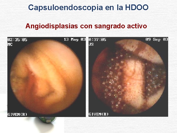 Capsuloendoscopia en la HDOO Angiodisplasias con sangrado activo 