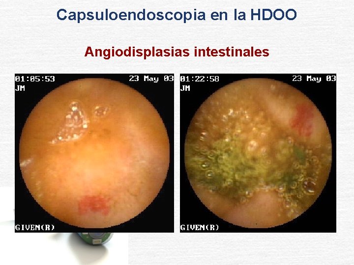 Capsuloendoscopia en la HDOO Angiodisplasias intestinales 