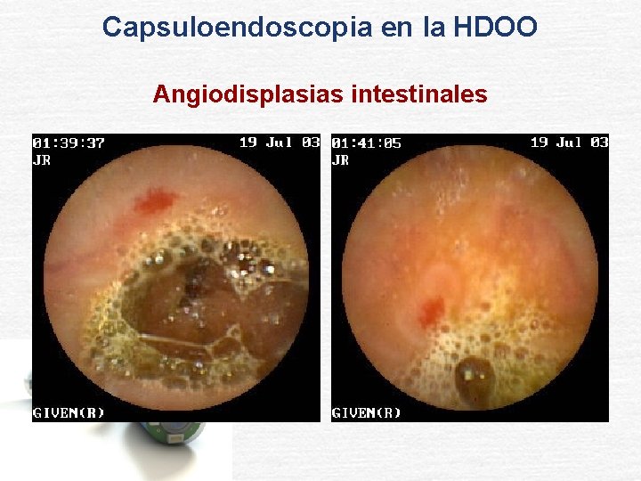 Capsuloendoscopia en la HDOO Angiodisplasias intestinales 