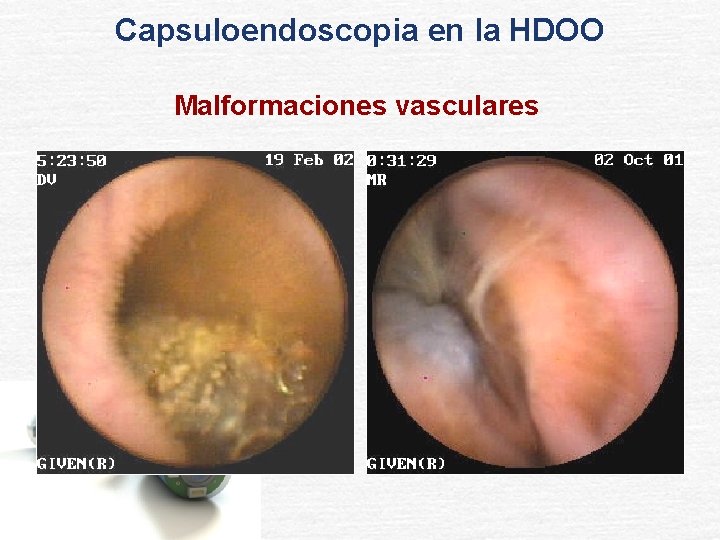 Capsuloendoscopia en la HDOO Malformaciones vasculares 