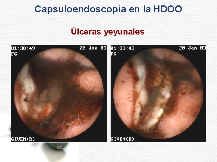 Capsuloendoscopia en la HDOO Úlceras yeyunales 