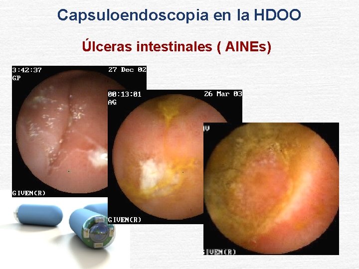 Capsuloendoscopia en la HDOO Úlceras intestinales ( AINEs) 