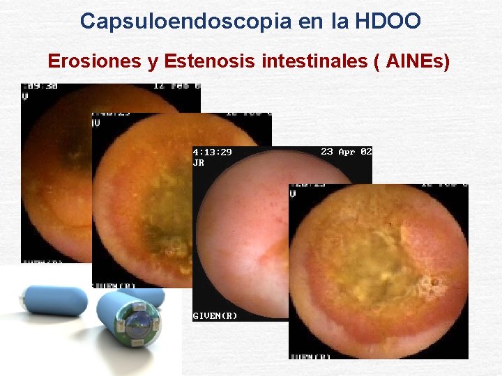 Capsuloendoscopia en la HDOO Erosiones y Estenosis intestinales ( AINEs) 