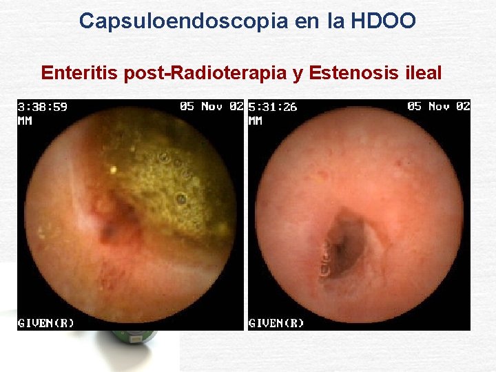 Capsuloendoscopia en la HDOO Enteritis post-Radioterapia y Estenosis ileal 