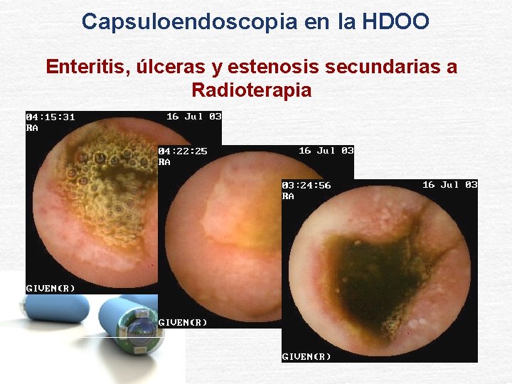 Capsuloendoscopia en la HDOO Enteritis, úlceras y estenosis secundarias a Radioterapia 