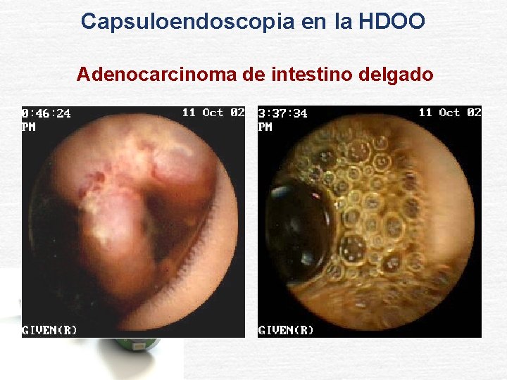 Capsuloendoscopia en la HDOO Adenocarcinoma de intestino delgado 