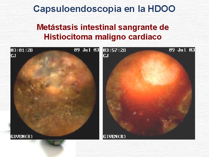 Capsuloendoscopia en la HDOO Metástasis intestinal sangrante de Histiocitoma maligno cardiaco 