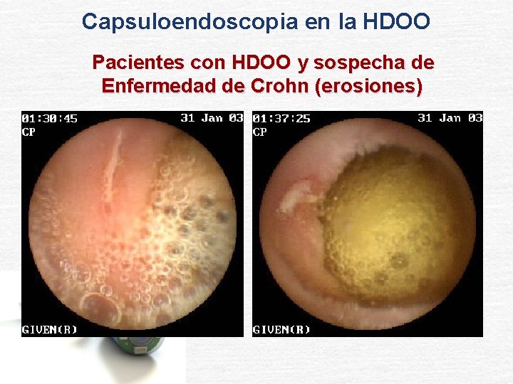 Capsuloendoscopia en la HDOO Pacientes con HDOO y sospecha de Enfermedad de Crohn (erosiones)