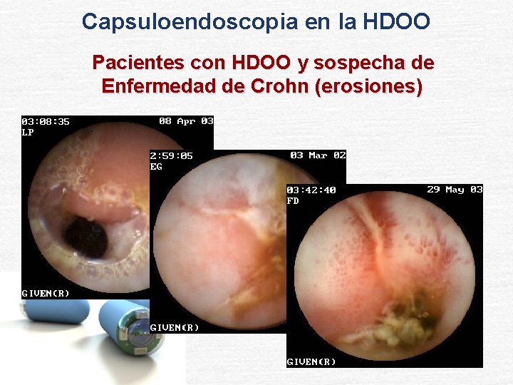 Capsuloendoscopia en la HDOO Pacientes con HDOO y sospecha de Enfermedad de Crohn (erosiones)