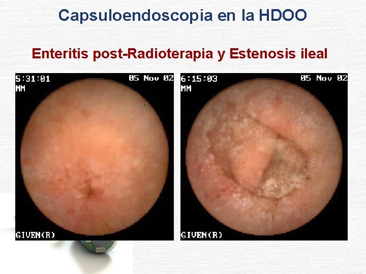 Capsuloendoscopia en la HDOO Enteritis post-Radioterapia y Estenosis ileal 