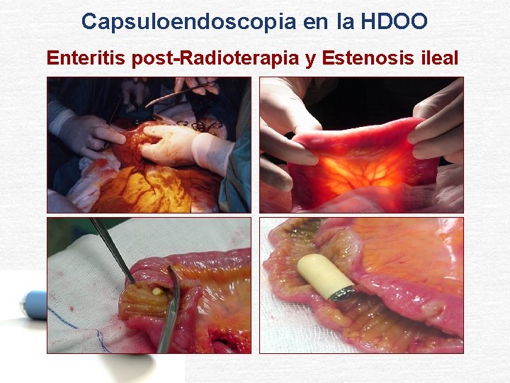 Capsuloendoscopia en la HDOO Enteritis post-Radioterapia y Estenosis ileal 