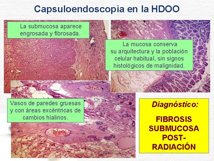 Capsuloendoscopia en la HDOO La submucosa aparece engrosada y fibrosada. La mucosa conserva su